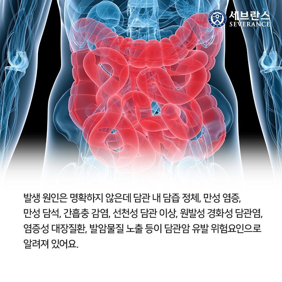 발생 원인은 명확하지 않은데 담관 내 담즙 정체, 만성 염증, 만성 담석, 간흡충 감염, 선천성 담관 이상, 원발성 경화성 담관염, 염증성 대장질환, 발암물질 노출 등이 담관암 유발 위험요인으로 알려져 있어요. 